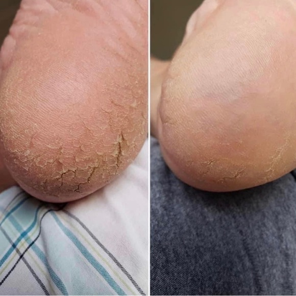 𝔻𝕠 𝕪𝕠𝕦 𝕤𝕦𝕗𝕗𝕖𝕣 𝕗𝕣𝕠𝕞 𝕤𝕠𝕣𝕖 𝕔𝕣𝕒𝕔𝕜𝕖𝕕 𝕙𝕖𝕖𝕝𝕤? - Picture 5 of 5